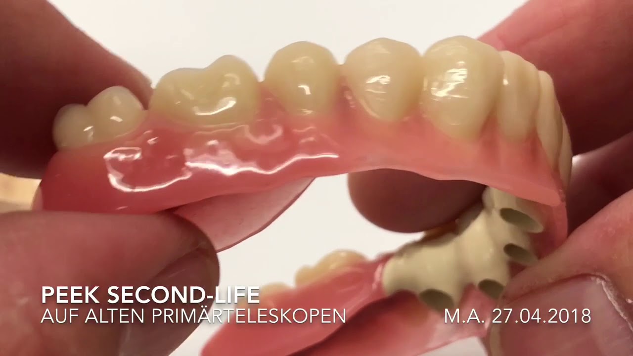 #SecondLife für alte Implantate