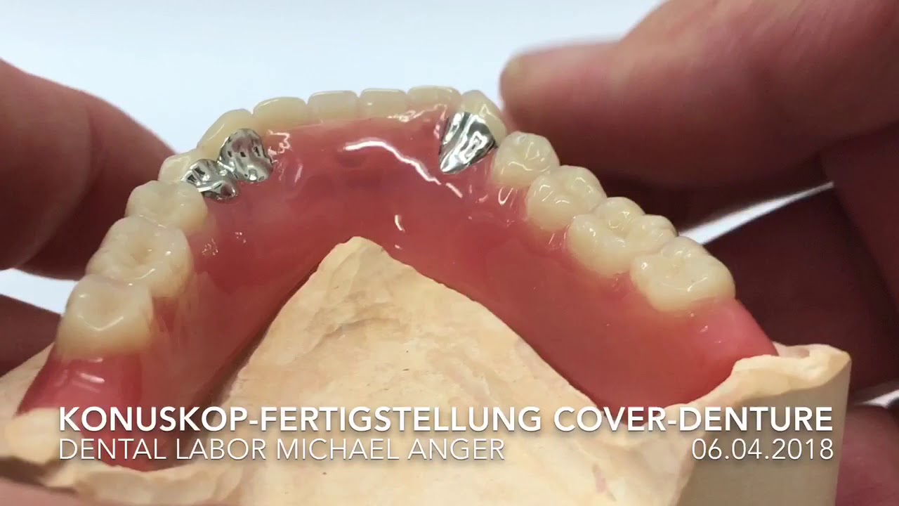 Konuskop-Prothesen mit Fertigstellung als Cover-Denture