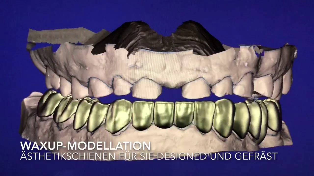 Ästhetische Aufbissschienen für Sie modelliert