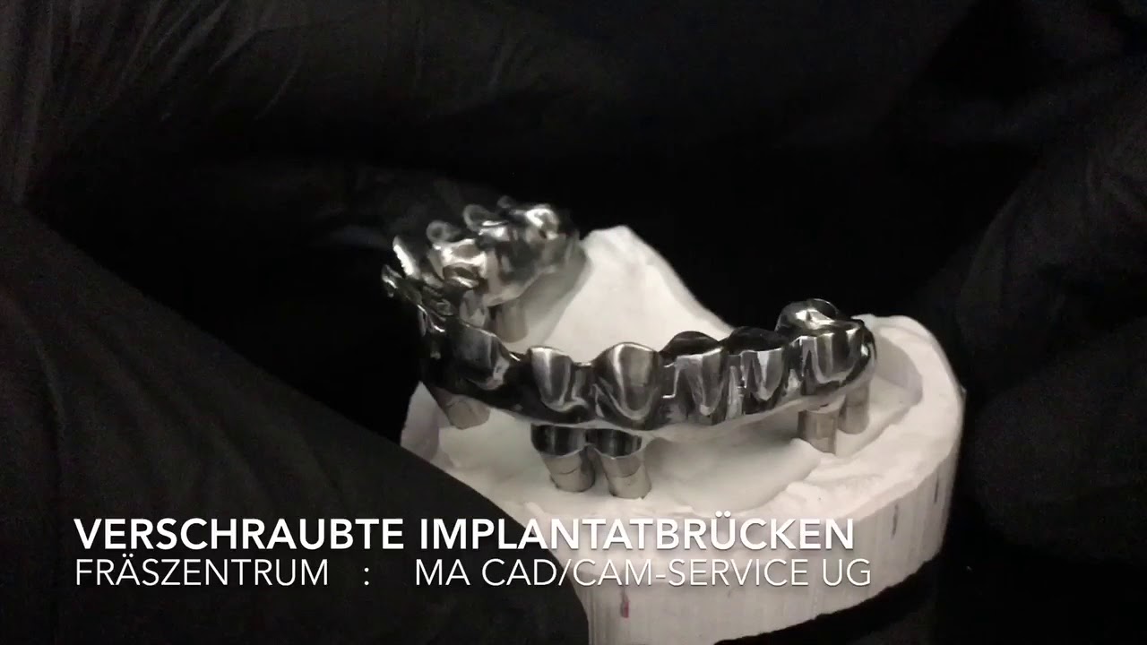 Verschraubte Implantatprothetik aus NaeM oder Titan