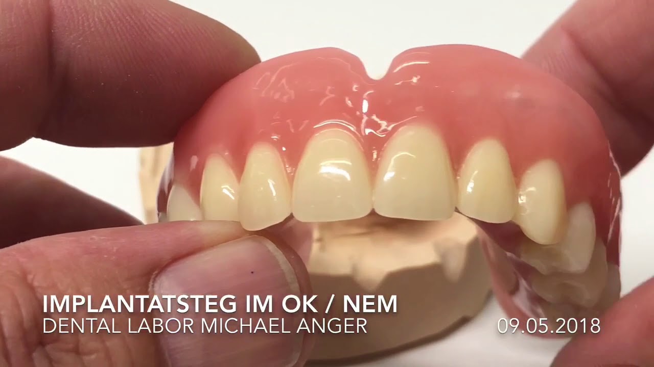 Implantatstege aus NEM