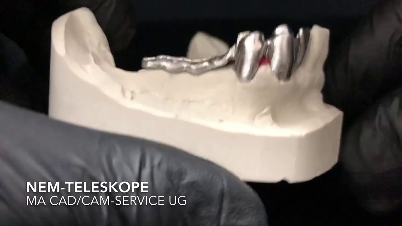 NEM -Teleskope per CAD/CAM mit oder ohne Modellguss