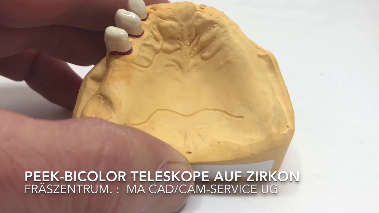 PEEK Teleskope auf Zirkon mit Rosa PEEK-Modellguss