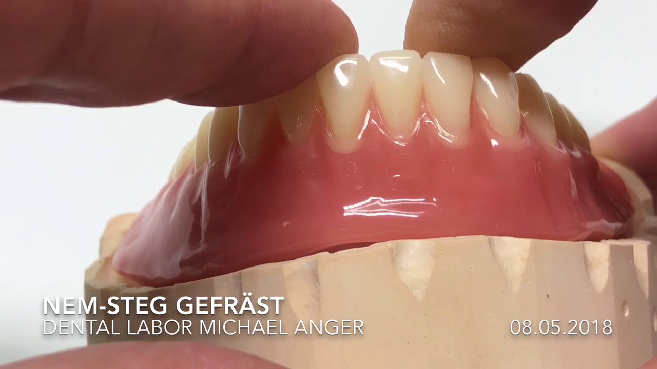 Implantatstege aus NEM